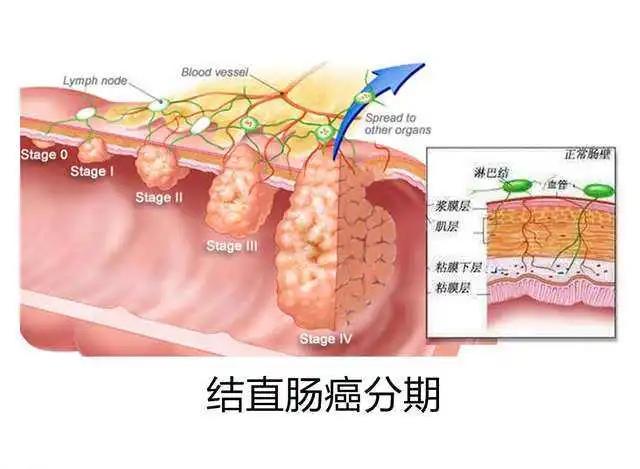 告别化疗之苦，免疫细胞疗法让癌症患者重获新生